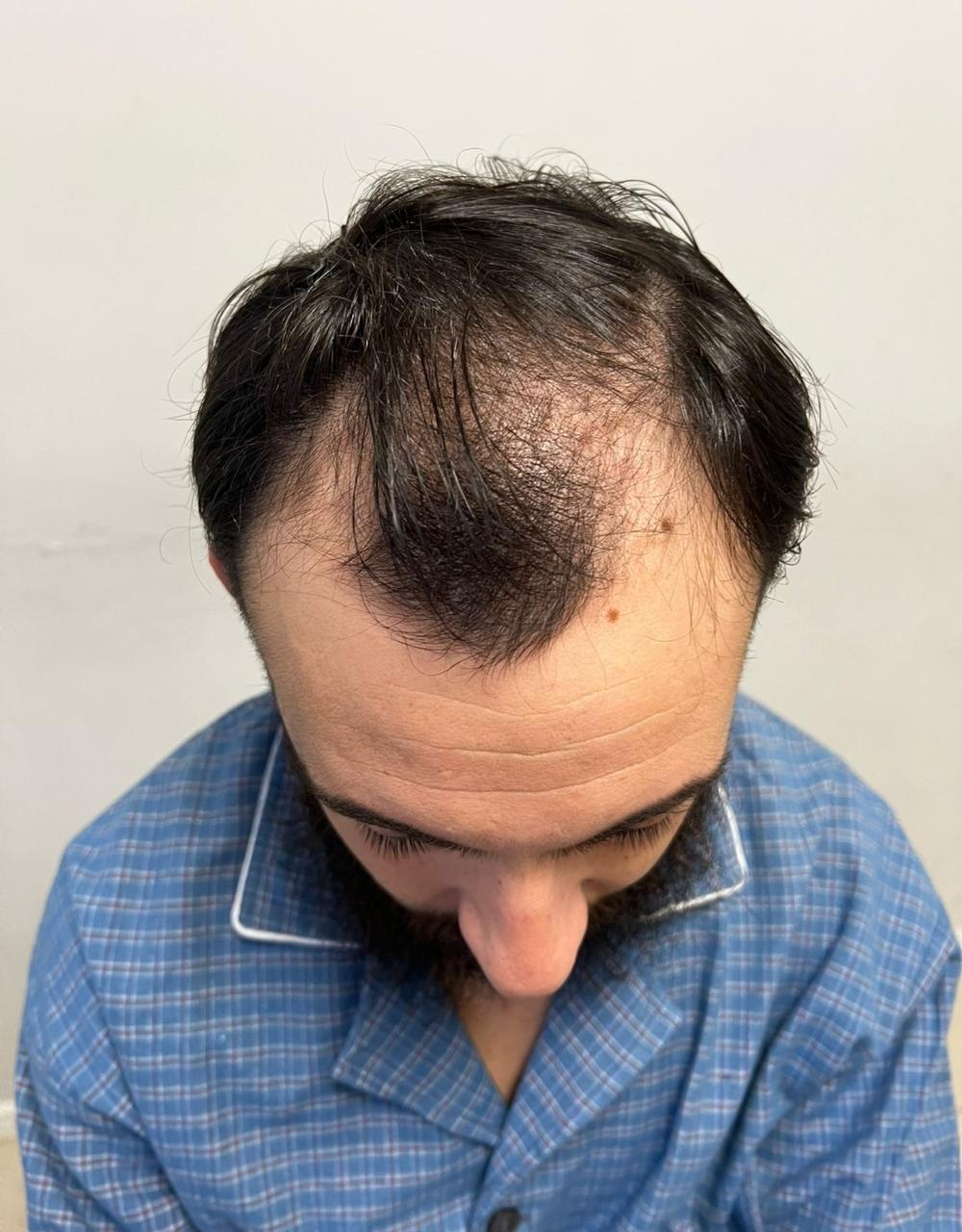 Antes del implante capilar