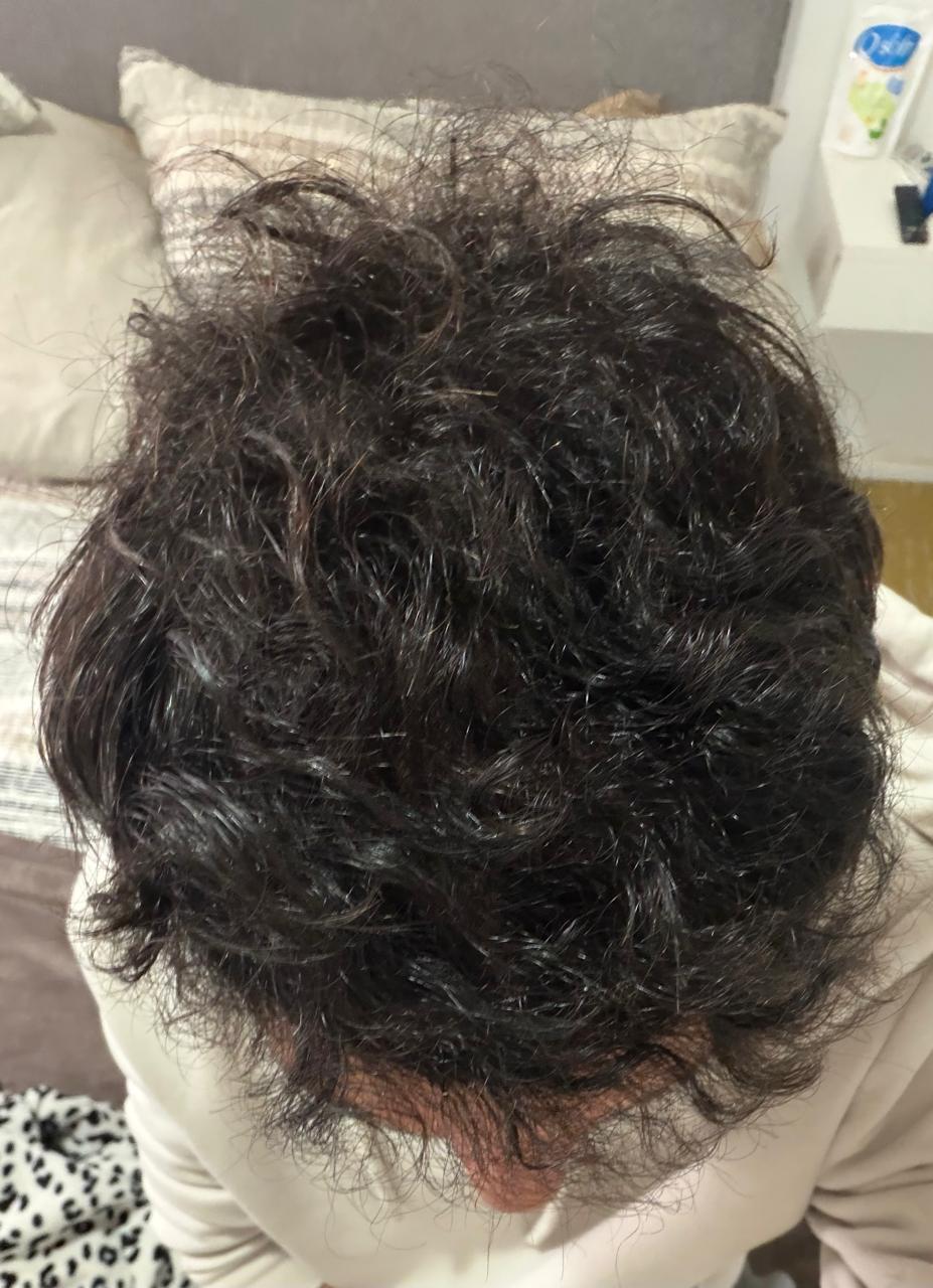 Despu&eacute;s del implante capilar