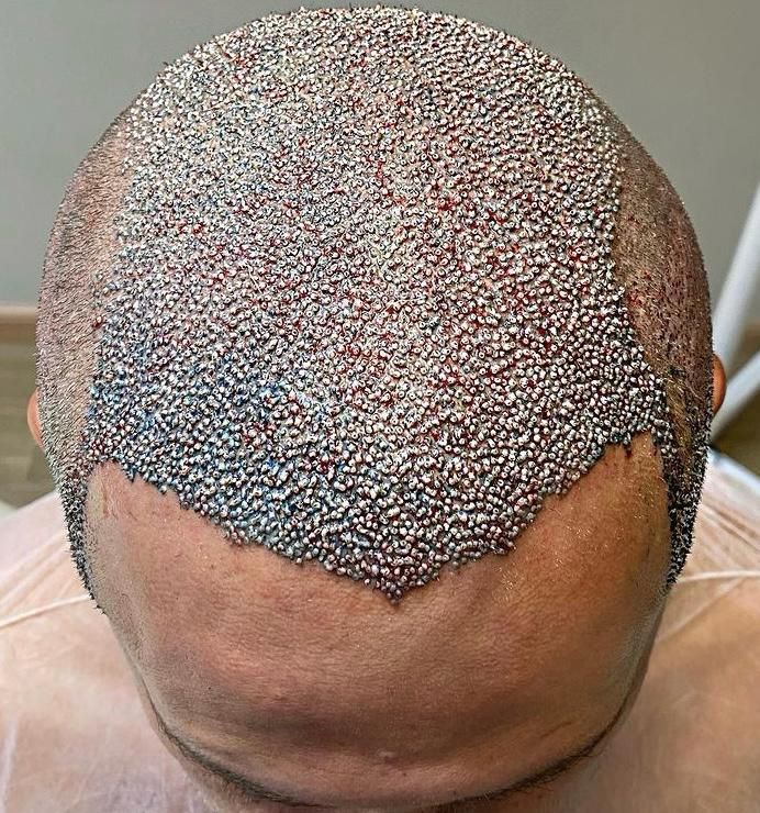 Resultado de implante capilar FUE: injertos capilares de cerca