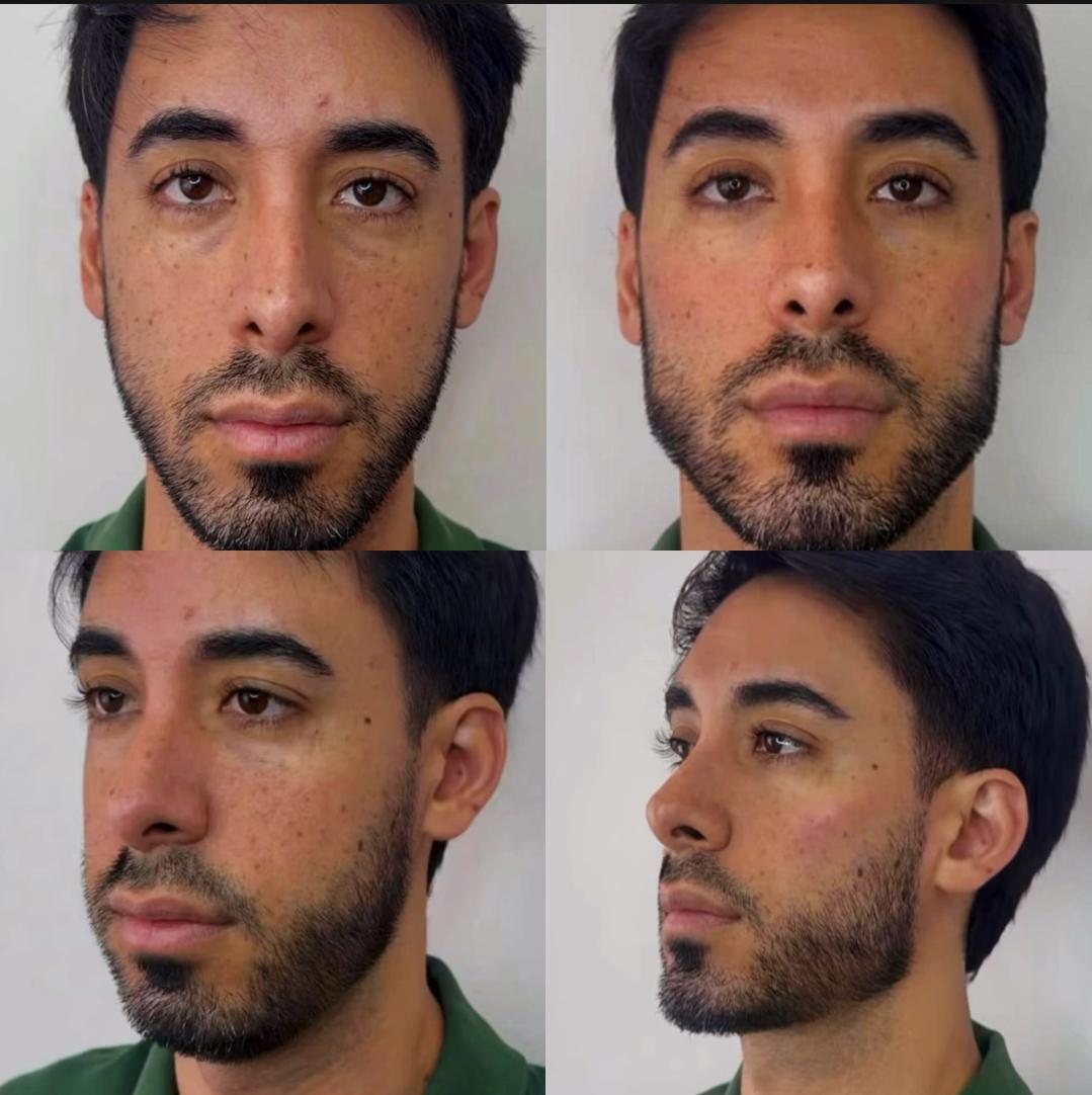 Procedimiento de armonización facial por la Dra. Soledad Suarez