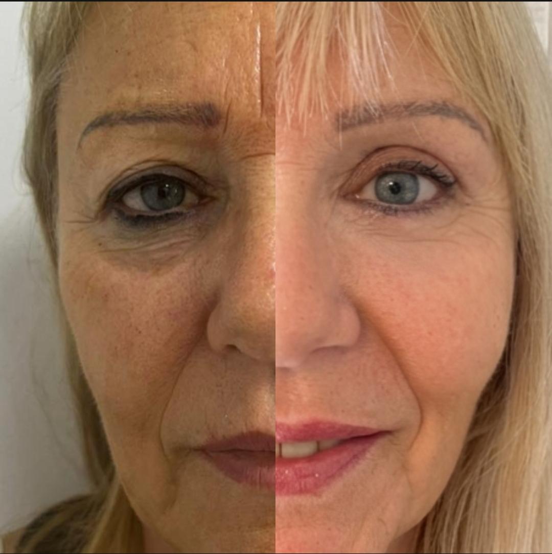 Procedimiento de blefaroplastia