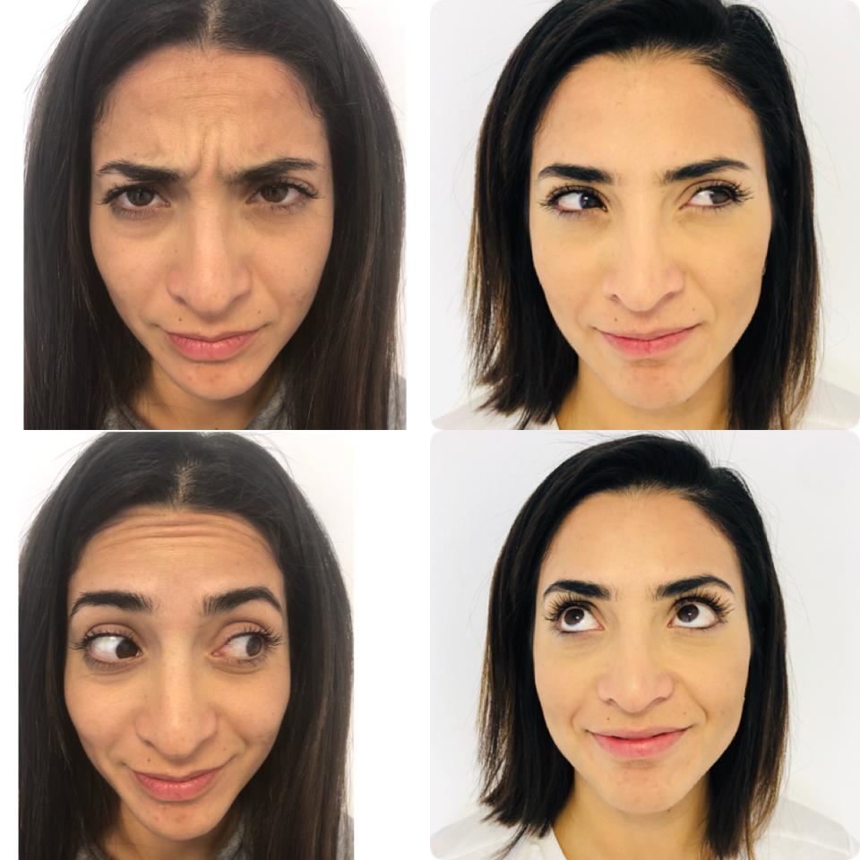 Aplicación de Botox por la Dra. Soledad Suarez