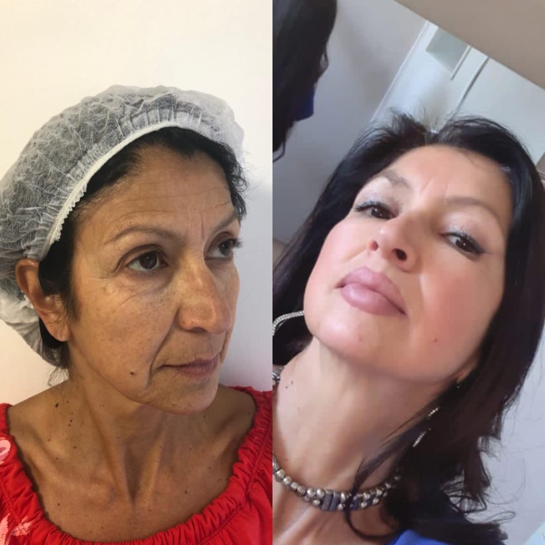 Procedimiento de lifting facial en la clínica
